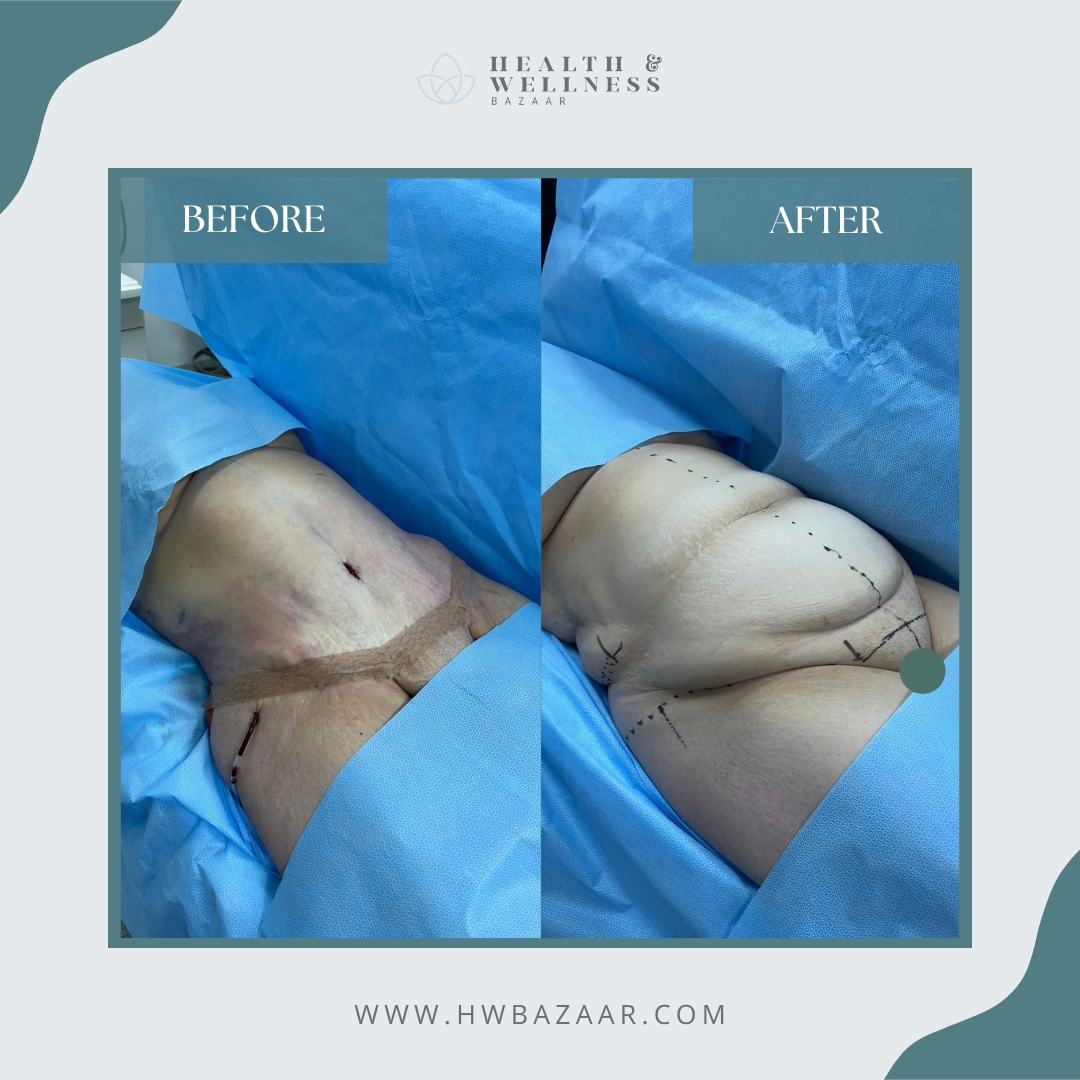 Tummy Tuck Cost in Mexico: Your Path to a Sculpted Stomach!