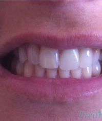Aesthetic Partial Denture