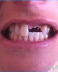 Aesthetic Partial Denture