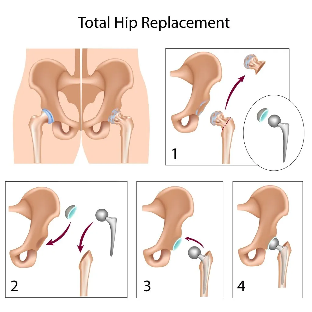 Hip-implant