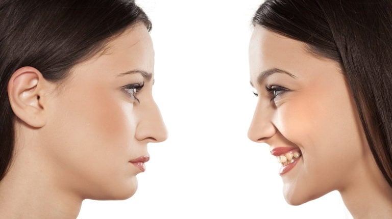 The Top 5 Questions About Rhinoplasty Answered