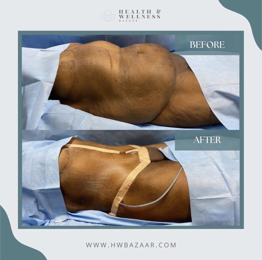 best cosmetic surgeons in Mexico