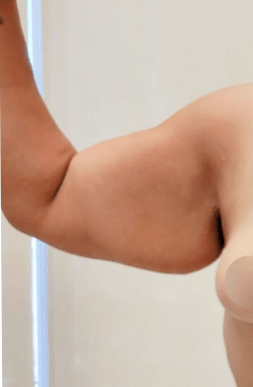 Before Arm Lift Surgery | Tijuana, Mexico