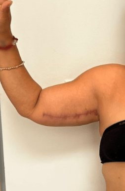 Arm Lift (Brachioplasty) - After Photo | Tijuana, Mexico