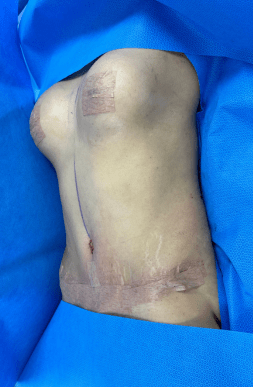 Post-Op Mommy Makeover with Breast Augmentation | Tijuana, Mexico