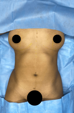 Before Breast Lift with Implants & Lipo | Tijuana, Mexico