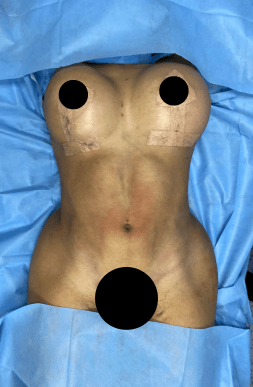Post-Op Breast Lift with Implants & Lipo | Tijuana, Mexico
