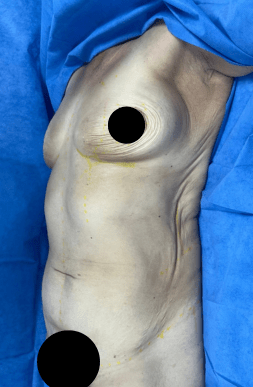 Before Natural Mommy Makeover with Breast Implants | Tijuana, Mexico