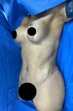 Post-Op Natural Mommy Makeover with Breast Implants | Tijuana, Mexico