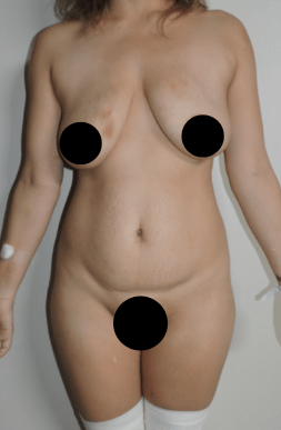 mommy makeover in tijuana patient before photo