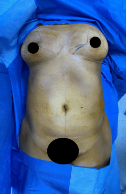 Before Mommy Makeover with Breast Lift & Tummy Tuck | HWBazaar Tijuana