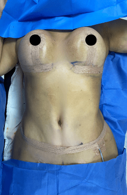 Post-Op Mommy Makeover with Breast Lift & Tummy Tuck | HWBazaar Tijuana
