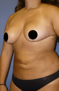 Post-Op Breast Reduction Results | Tijuana, Mexico