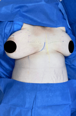 Before Breast Reduction Surgery | Tijuana, Mexico
