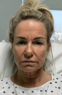 Facelift-Eyelid_3A.png