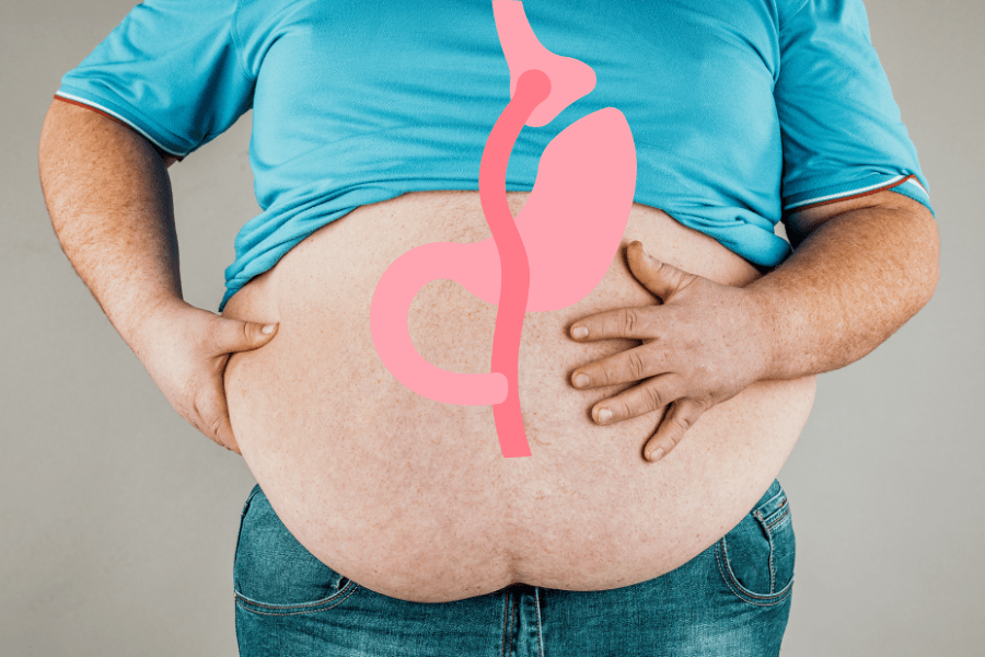 Gastric bypass surgery in Tijuana, Mexico, showing stomach reduction for weight loss.