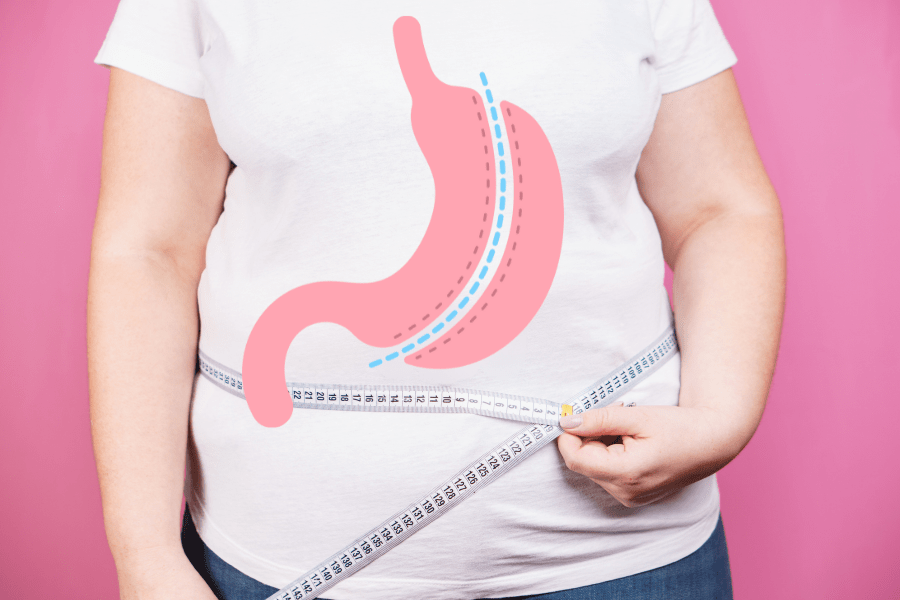 Illustration of a gastric sleeve procedure highlighting gastric sleeve in Tijuana, Mexico, for those interested in medical tourism and weight loss solutions.