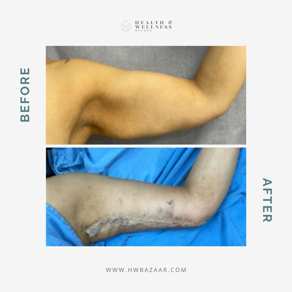 Before and after images of an arm lift surgery performed by Health & Wellness Bazaar, showing improved arm contour and post-surgical healing.