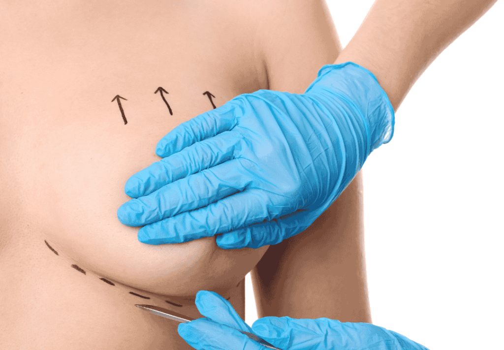 Surgeon marking a patient’s breast with arrows and guidelines before a breast lift procedure at Health & Wellness Bazaar in Tijuana, Mexico.