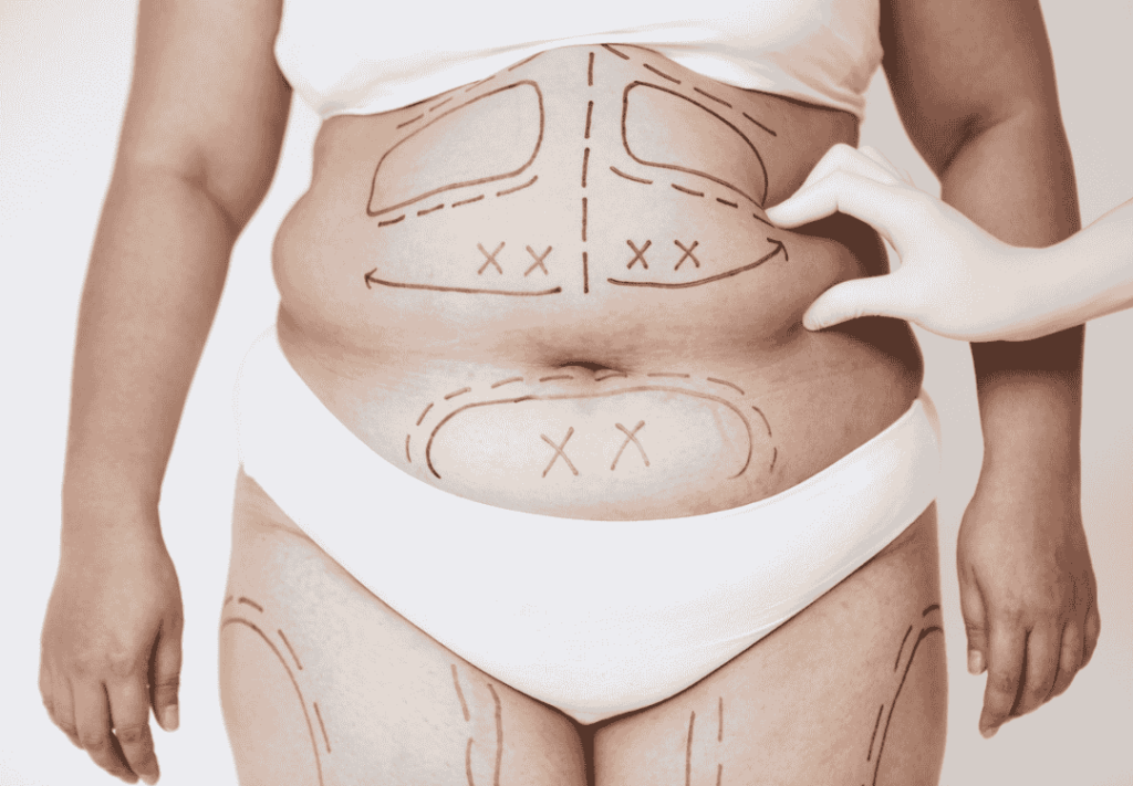 A patient with pre-surgical markings on the abdomen and thighs in preparation for skin removal after weight loss in tijuana