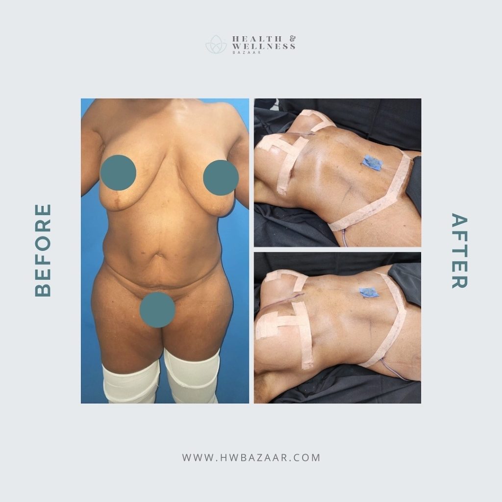 Side-by-side comparison of a woman before and after a mommy makeover with breast enhancement and body contouring at Health & Wellness Bazaar in Tijuana, Mexico.