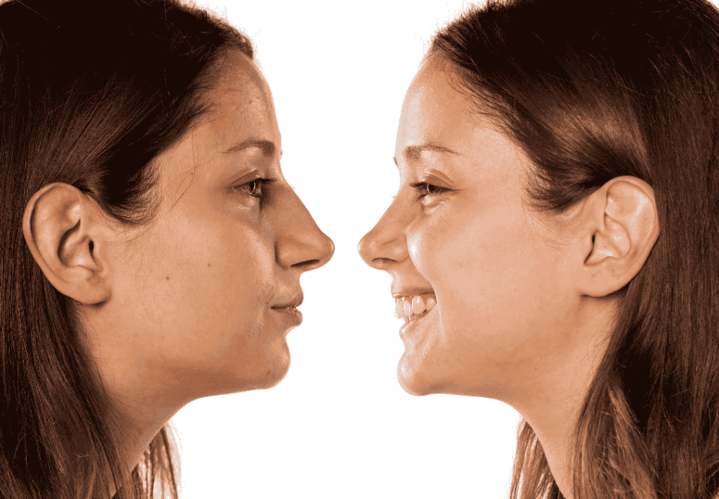 Rhinoplasty before and after comparison in Tijuana, Mexico, showing nose reshaping results.