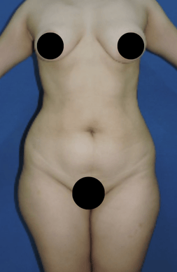 Front view of a patient's body before liposuction surgery for fat removal and body sculpting.
