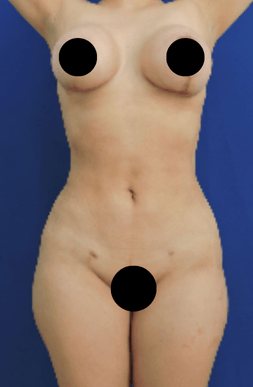After liposuction surgery showing a toned and sculpted body with improved abdominal contour.