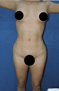 Lipo-2B-1.png