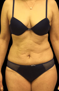 Lipo-4A.png