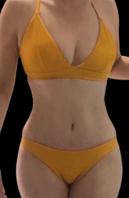 A woman showcasing a toned and sculpted figure after liposuction, highlighting a slim waistline and enhanced body contour.