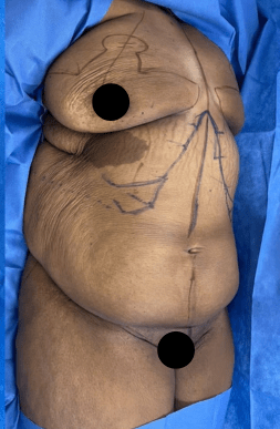 Woman’s midsection before a mommy makeover, showing excess skin and fat with pre-surgical markings for body contouring.