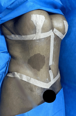 Woman’s midsection after a mommy makeover with liposuction and body contouring, showing post-surgical markings and improved abdominal definition.
