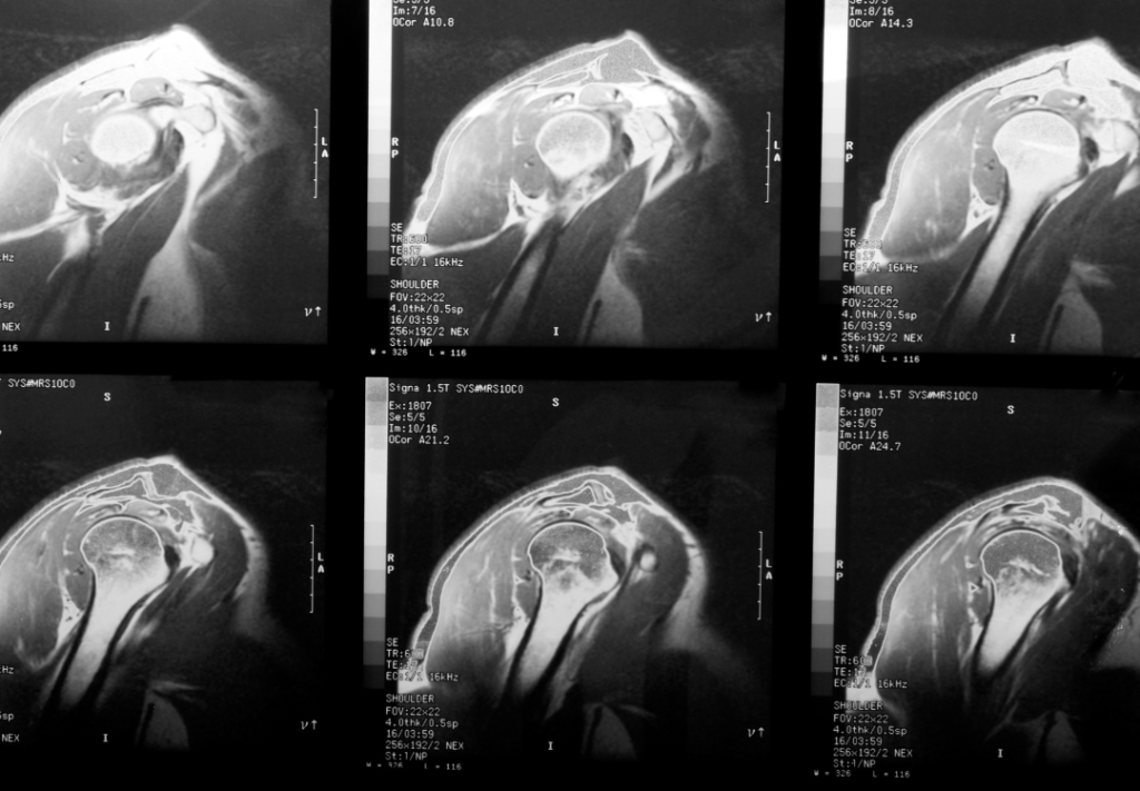 Medical MRI scan showing multiple views of a rotator cuff injury in the shoulder, highlighting soft tissue and joint structures.