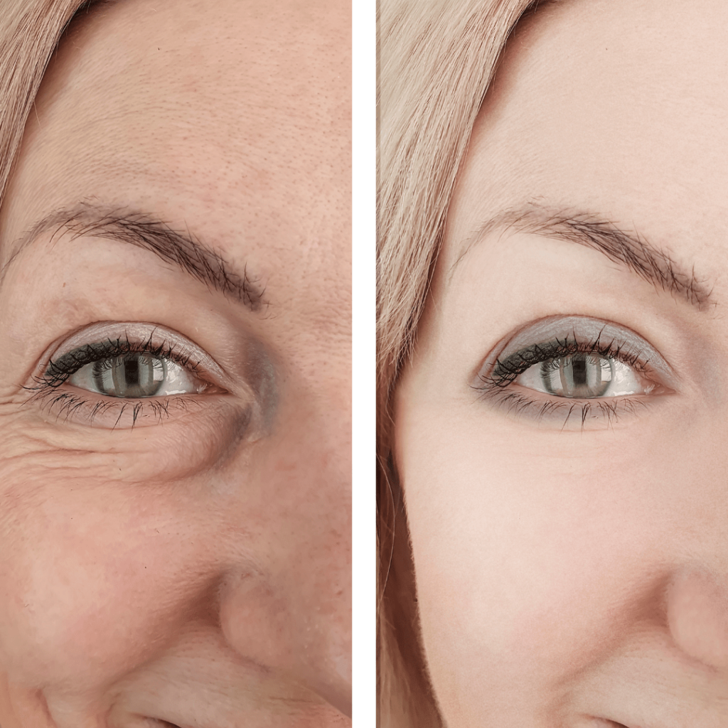 Close-up of a patient's face showing before and after plastic surgery results from having surgery in Tijuana, Mexico