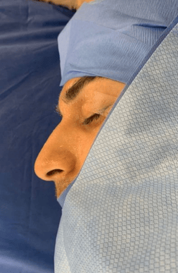 Patient undergoing rhinoplasty surgery, pre-surgical preparation for nasal reshaping.