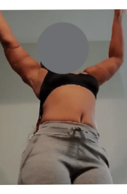 Post-Op Skin Removal Results | Tijuana, Mexico