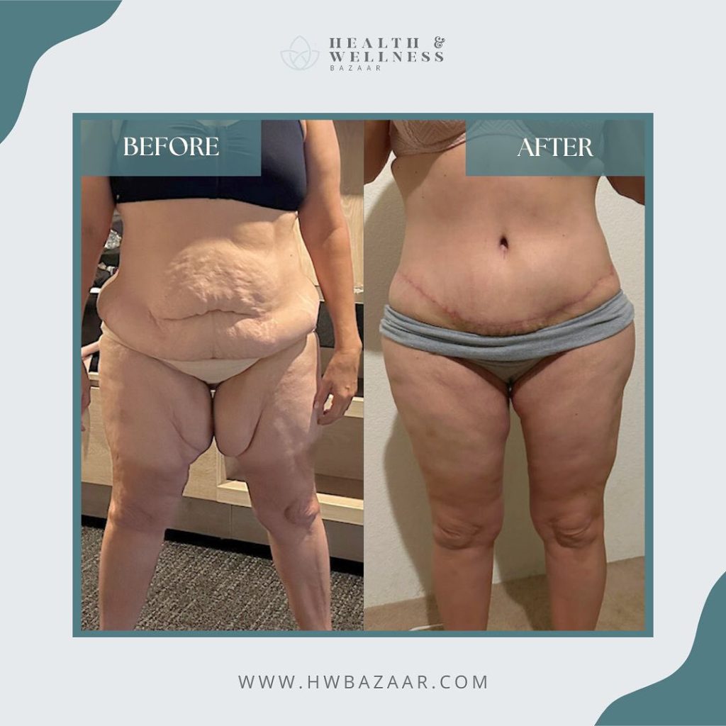 Before and after images of skin removal surgery performed by Health & Wellness Bazaar, showing a significant transformation with improved body contour.