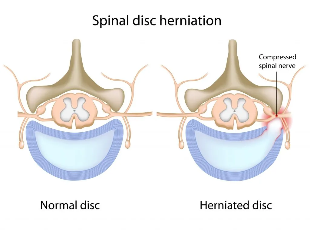Medical illustration comparing a normal spinal disc and a herniated disc causing compression of the spinal nerve, labeled with anatomical structures.