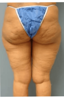 Thigh_1A.png
