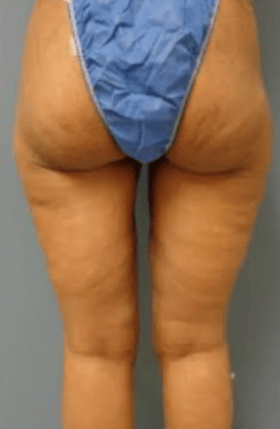 Thigh_1B.png