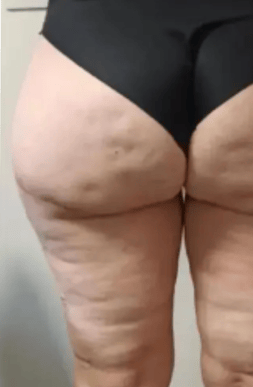 Thigh_2B.png