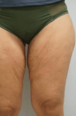Before Thigh Lift Surgery | Tijuana, Mexico