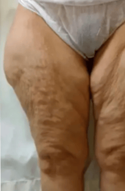 Pre-Op Thigh Lift Photo | Tijuana, Mexico