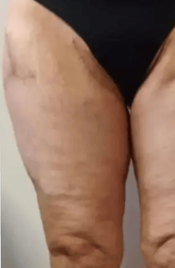 Before Thigh Lift - Different Patient | Tijuana, Mexico