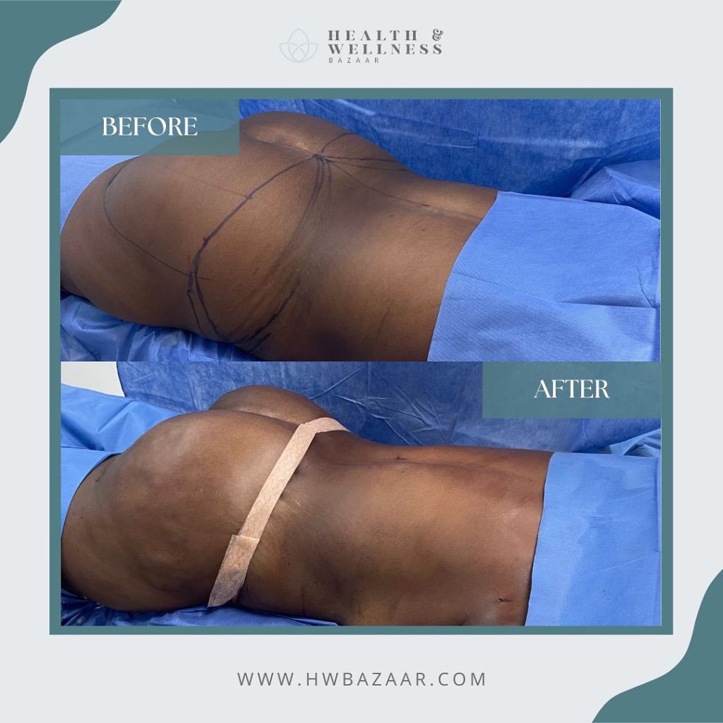 Before and after images of a Brazilian Butt Lift (BBL) procedure performed by Health & Wellness Bazaar, showing enhanced volume and contour.