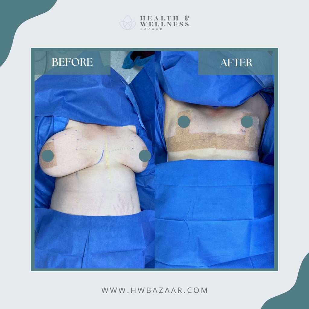 Side-by-side comparison of a woman before and after breast reduction surgery at Health & Wellness Bazaar in Tijuana, Mexico, showing reduced breast size and post-surgical bandages.