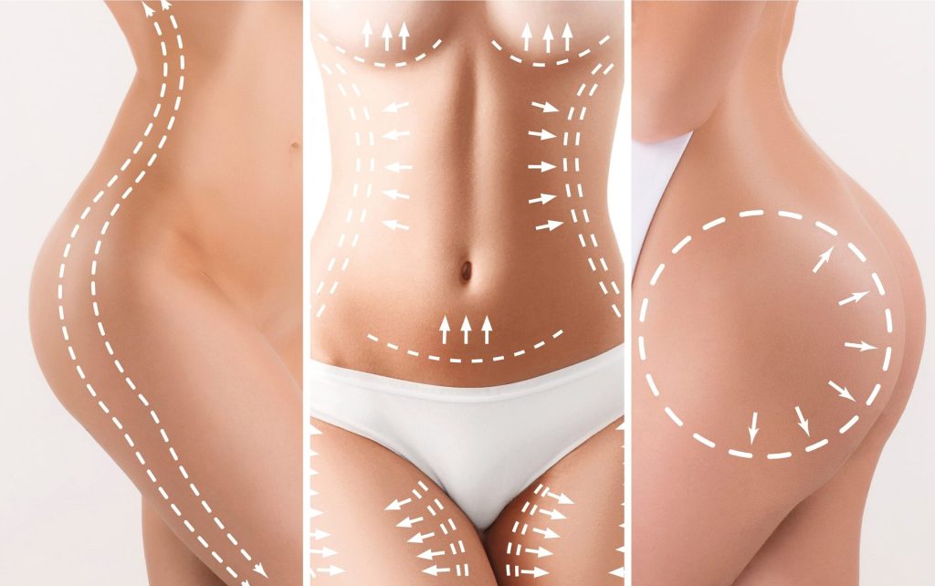 Body contouring and sculpting procedure in Tijuana, Mexico, with surgical markings for liposuction.