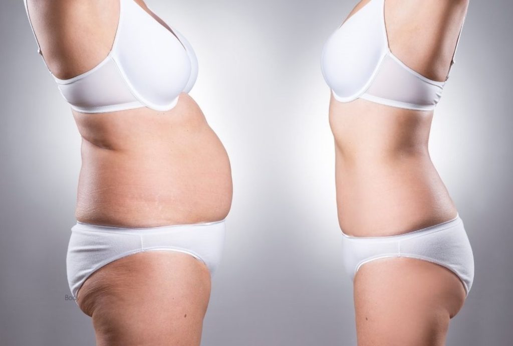 Woman showcasing her body transformation after a mommy makeover in Tijuana, Mexico, including breast lift and tummy tuck procedures