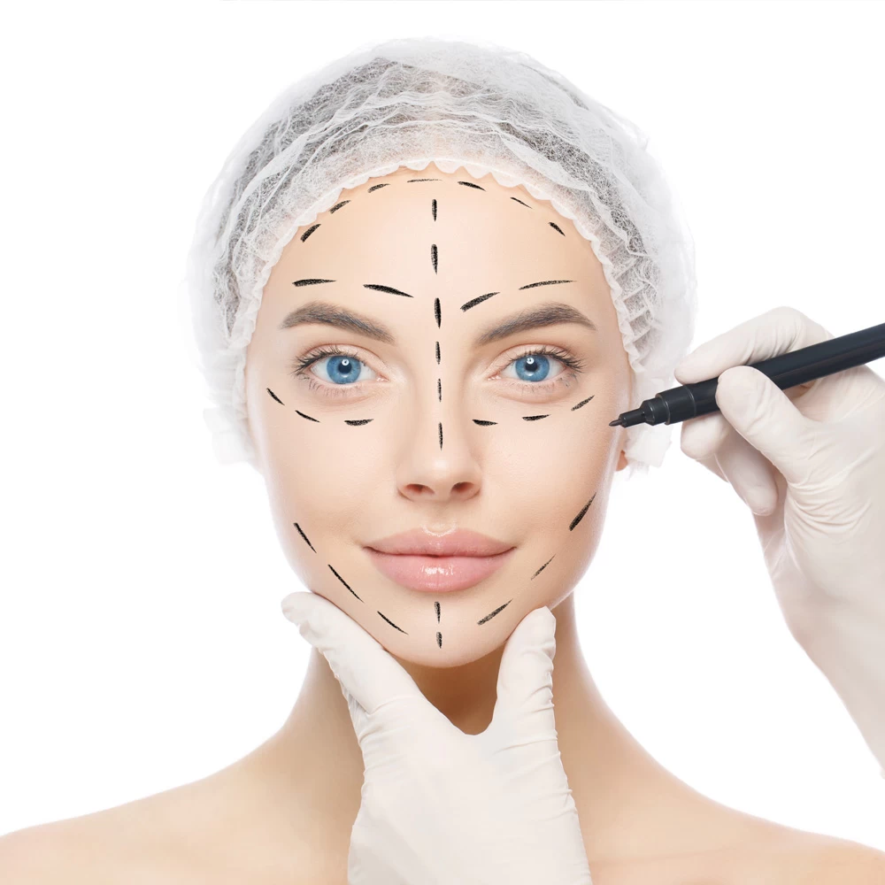 Woman preparing for facelift surgery in Tijuana, Mexico, with pre-surgical markings on her face.